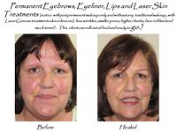 permanent makeup and anti-aging and laser skincare